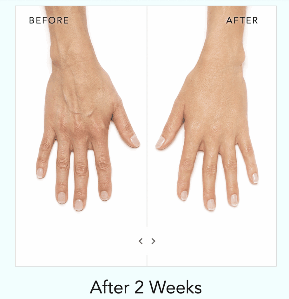 radiesse before and after