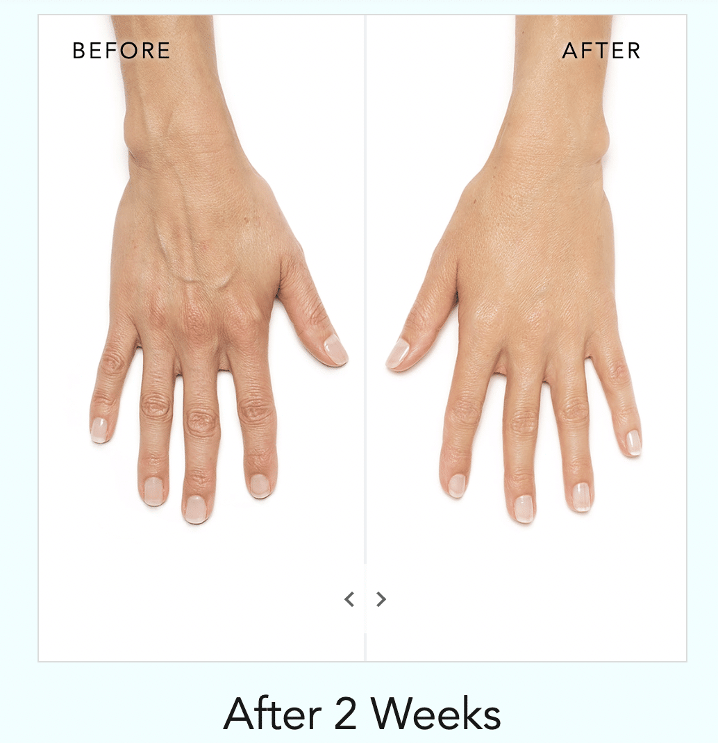 radiesse before and after