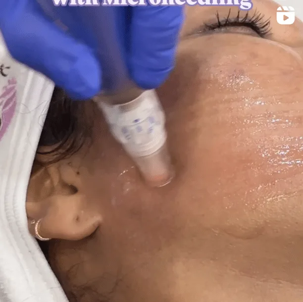 Professional microneedling treatment on patient's face at Enlightened Medical by Dr. Danelle Kutner.
