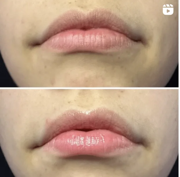Close-up before and after showing lips, with the bottom image featuring visibly plumper and glossier lips compared to the thinner lips in the top image